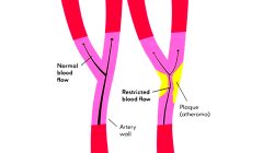 Blocked Arteries